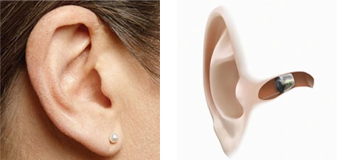 Najmniejsze na świecie aparaty słuchowe typu IIC, ukryte w kanale słuchowym i kompletnie niewidoczne dla innych osób.